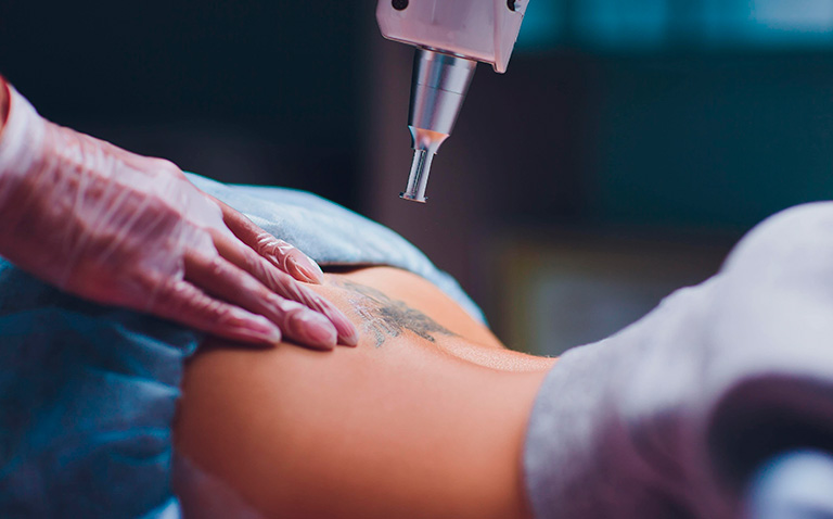 Beneficios de eliminar tus tatuajes en una clínica medicina estética